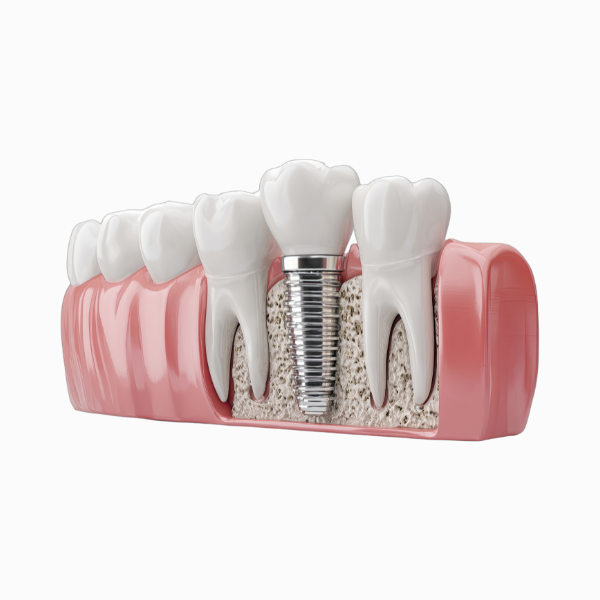 Implantes